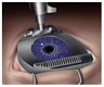 lasik_step2s.jpg